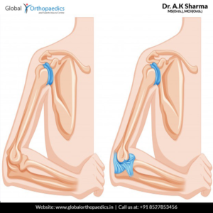 elbow replacement surgery