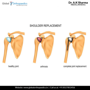 shoulder-replacement-surgery