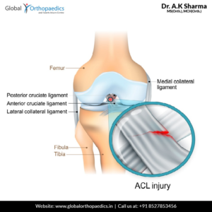 ACL injury