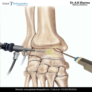 arthroscopic-surgery-of-wrist