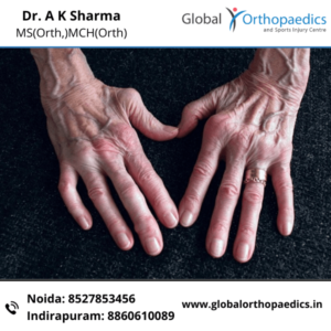 RHEUMATOID ARTHRITIS