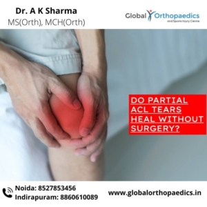 best ACL surgeon in Noida